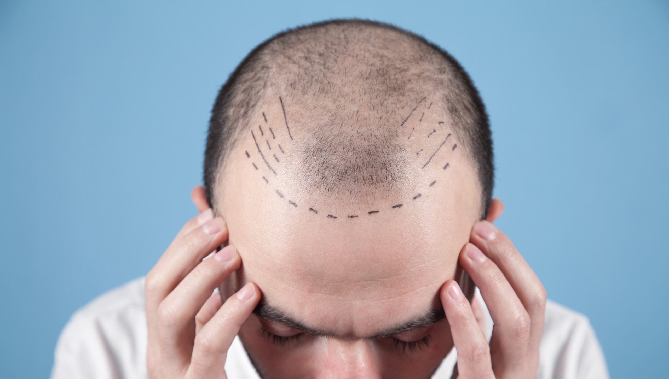 caucasian-bald-man-before-hair-transplantation