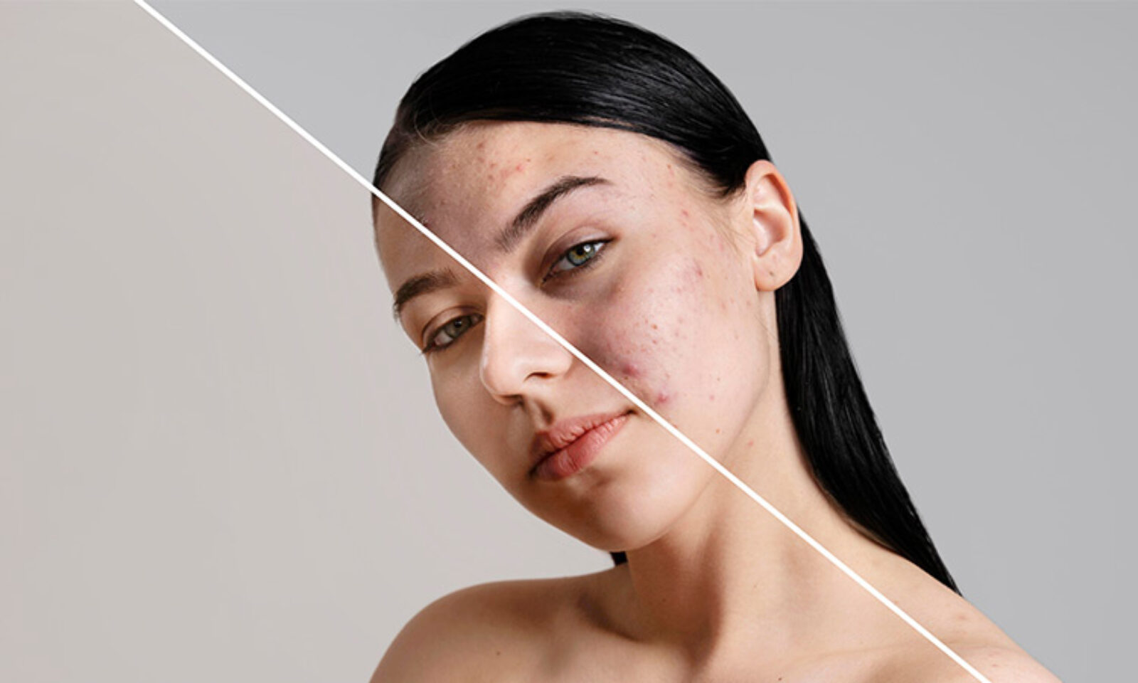 Hormonal Leke Tedavisi Nasıl Gerçekleştirilir?