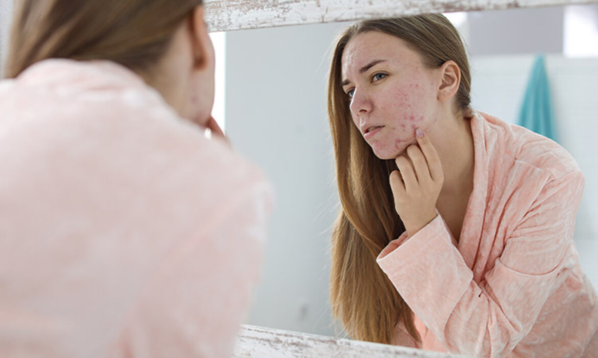 Kalıcı Akne Tedavisiyle Pürüzsüz Bir Cilde Kavuşun