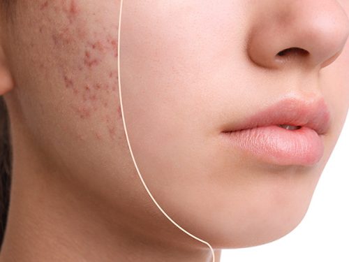 Akne İzlerine Karşı Etkili Tedaviler