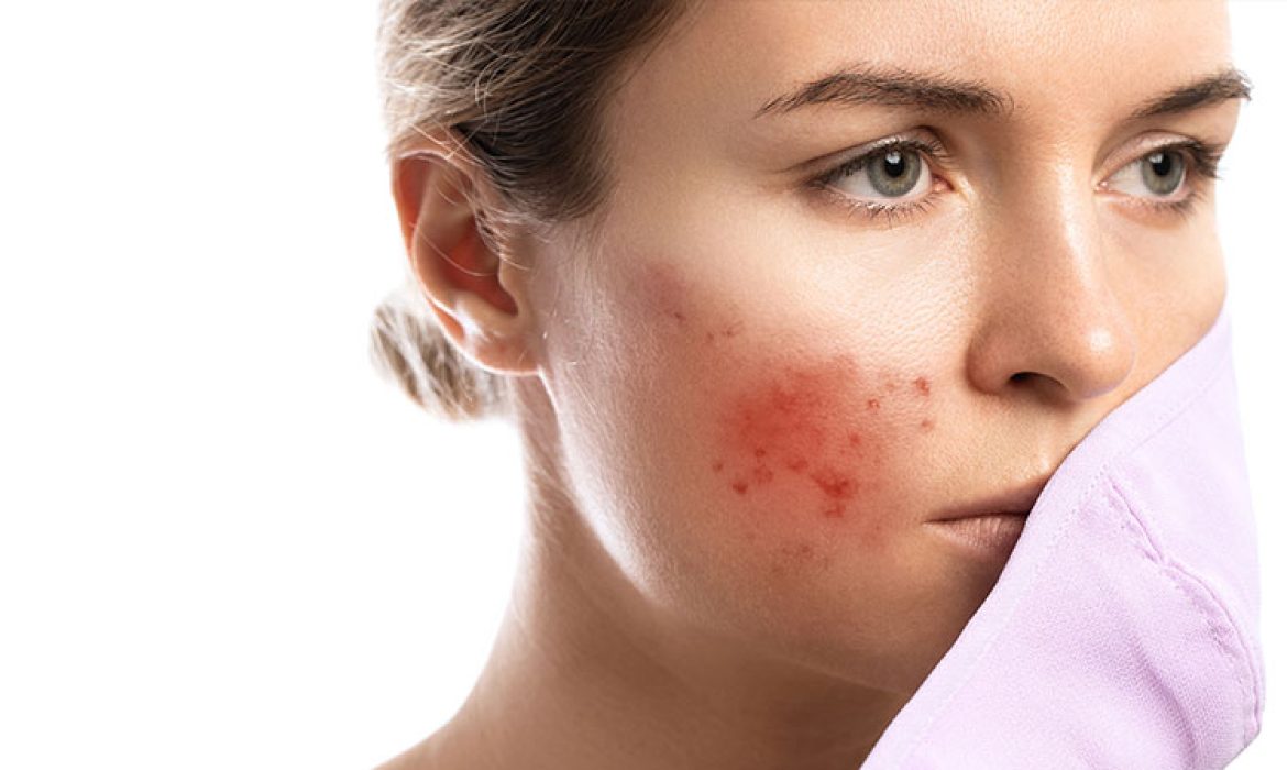 Kalıcı Akne İzleri İçin Tedavi Yöntemleri