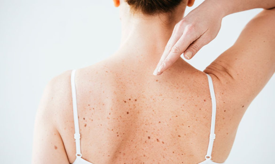 Vücut Lekeleri Tedavisinde Güncel Tedaviler