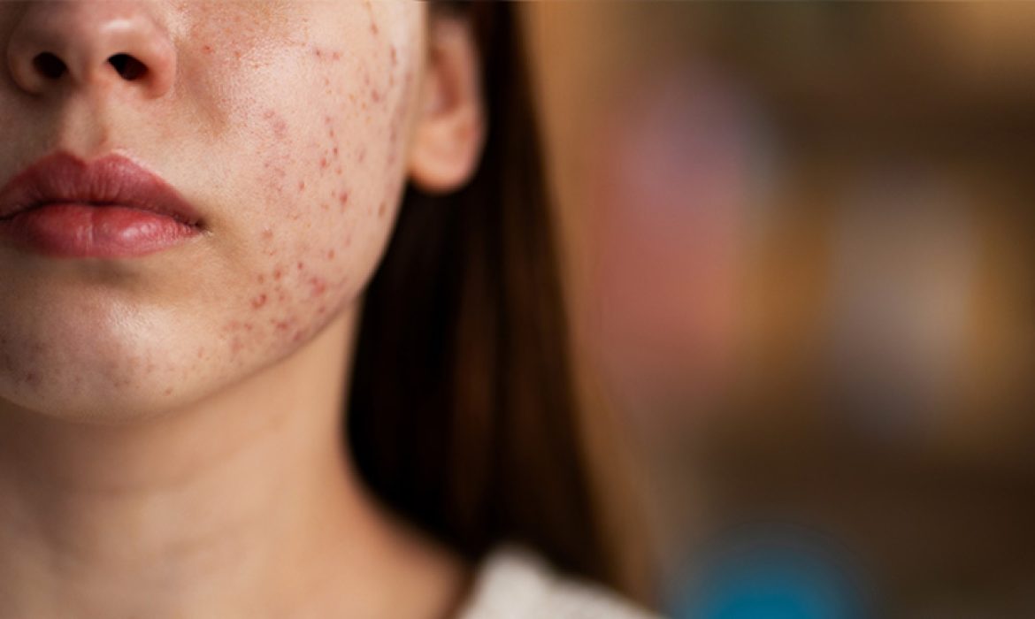 Kırmızı Sivilce Lekeleriyle Mücadelede Etkili Çözümler