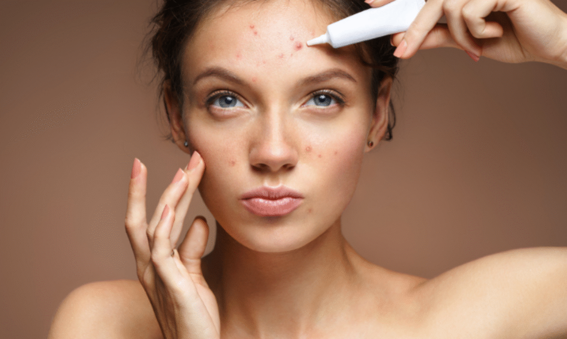 Akne Tedavisinde Yapılan 5 Yaygın Hata