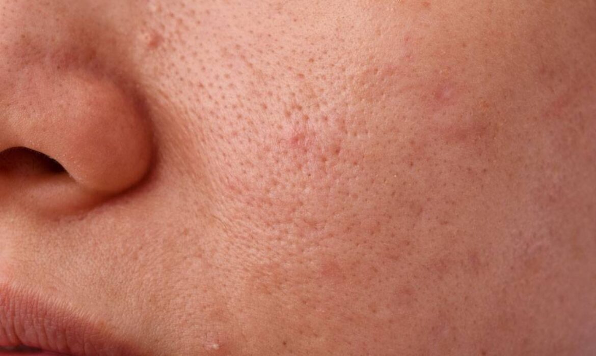 Ciltte Geniş G&ouml;zenek Sorunu: Sebepleri ve En Etkili Tedavi Y&ouml;ntemleri