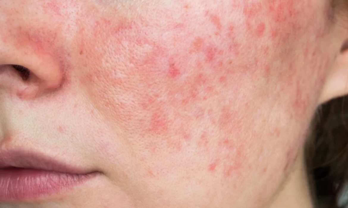 Rosacea (Gül Hastalığı) ile Yaşamak: Tetkikler, Tedaviler ve Günlük Bakım