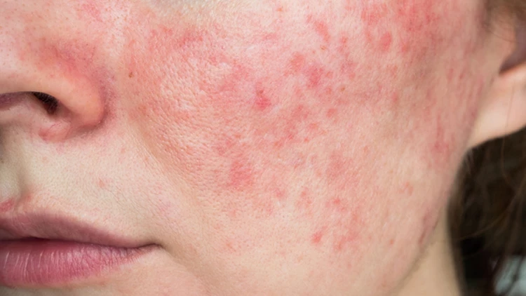 Rosacea (Gül Hastalığı) ile Yaşamak: Tetkikler, Tedaviler ve Günlük Bakım