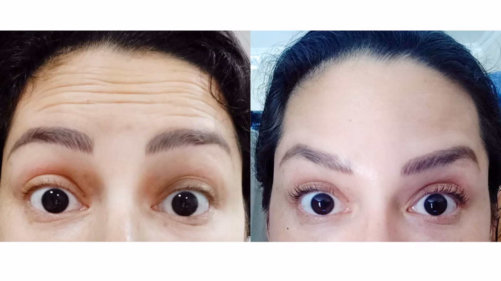 Mimik Kaybetmeden Gençleşmek: Hareketli Botox Uygulamaları Mümkün mü?