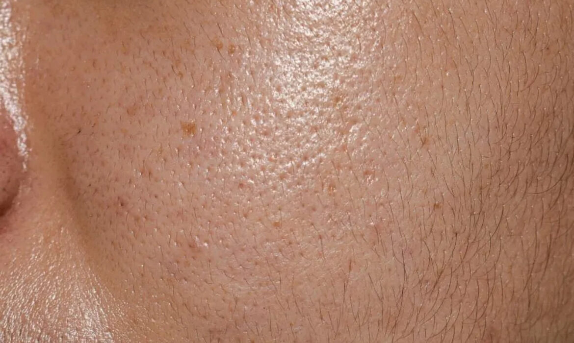 Ciltte Fazla Yağ &Uuml;retimi (Sebum Dengesizliği) Neden Olur?