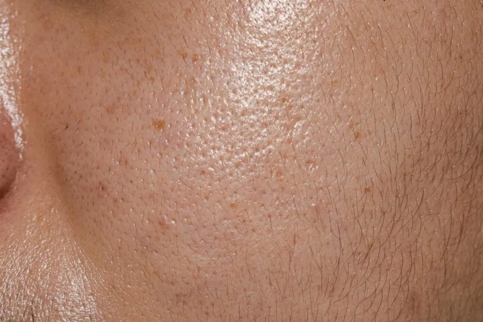 Ciltte Fazla Yağ &Uuml;retimi (Sebum Dengesizliği) Neden Olur?