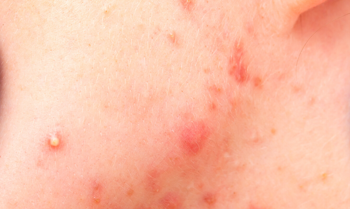 Hormonal Akne: Nedenleri ve Kalıcı &Ccedil;&ouml;z&uuml;m Yolları