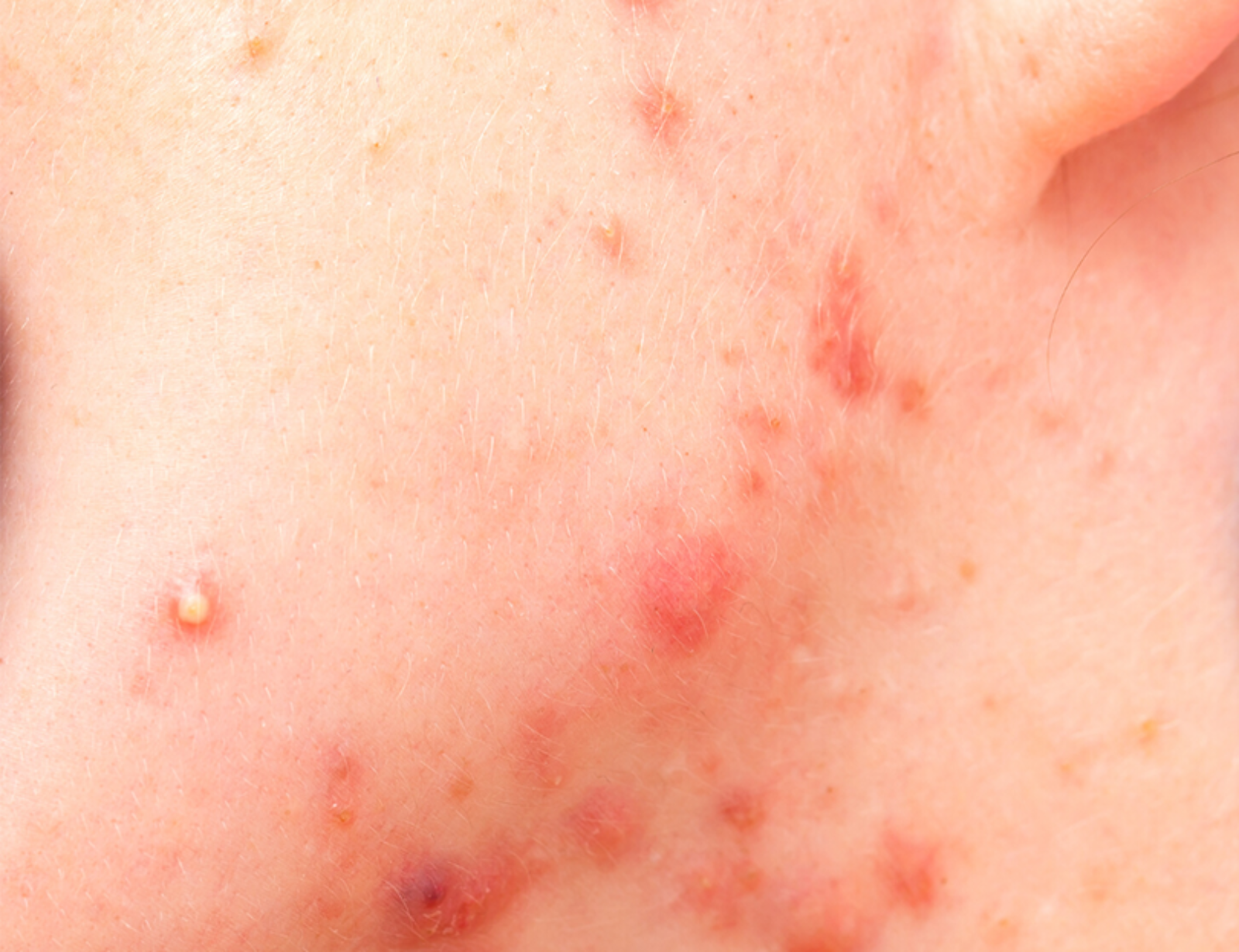 Hormonal Akne: Nedenleri ve Kalıcı &Ccedil;&ouml;z&uuml;m Yolları