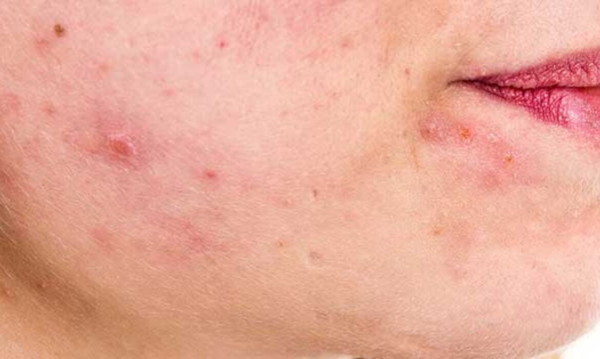 Ciltte İnflamasyon: Sessiz Hasarın G&ouml;r&uuml;nmeyen Etkisi